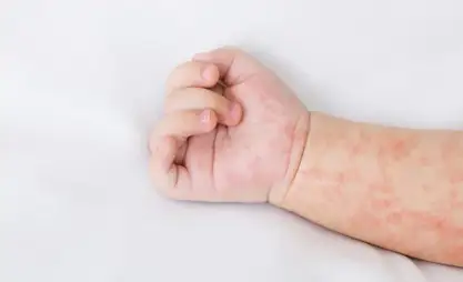More than 5,000 cases of measles registered in Kyrgyzstan