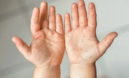 Over 4,800 measles cases registered in Kyrgyzstan, 8 children died