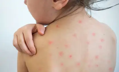 Kyrgyzstan registers 8,211 cases of measles