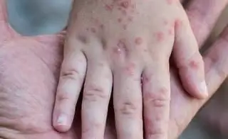 Situation with measles incidence remains acute in Kyrgyzstan