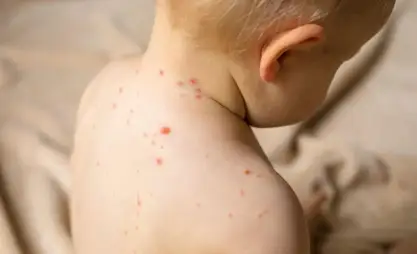 Kyrgyzstan sees decline in cases of measles since June