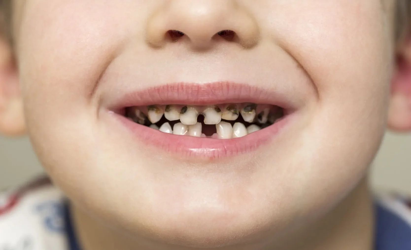 child-rotten-teeth.webp