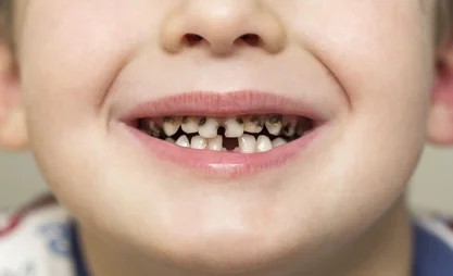 child-rotten-teeth.webp