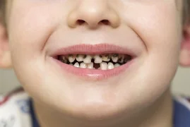 child-rotten-teeth.webp