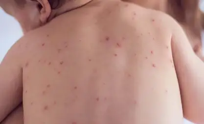 Almost 7,000 measles cases registered in Kyrgyzstan
