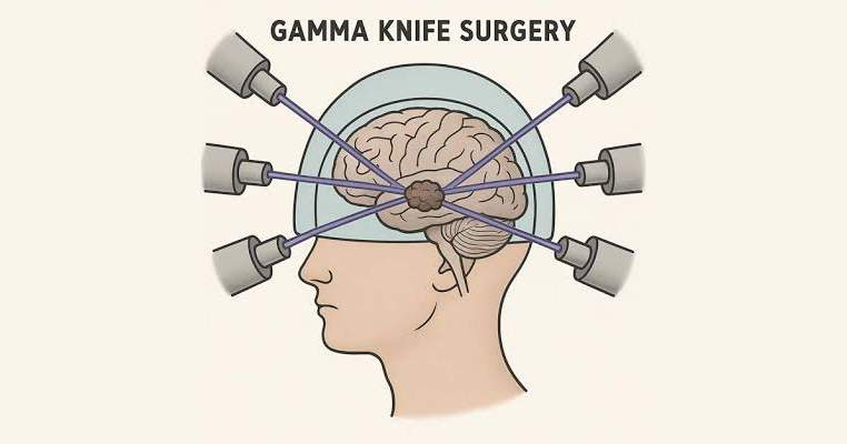 Gamma knife delivered to Kyrgyzstan for patient treatment