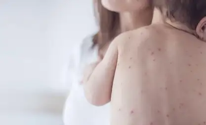 Measles  situation in Kyrgyzstan remains tense